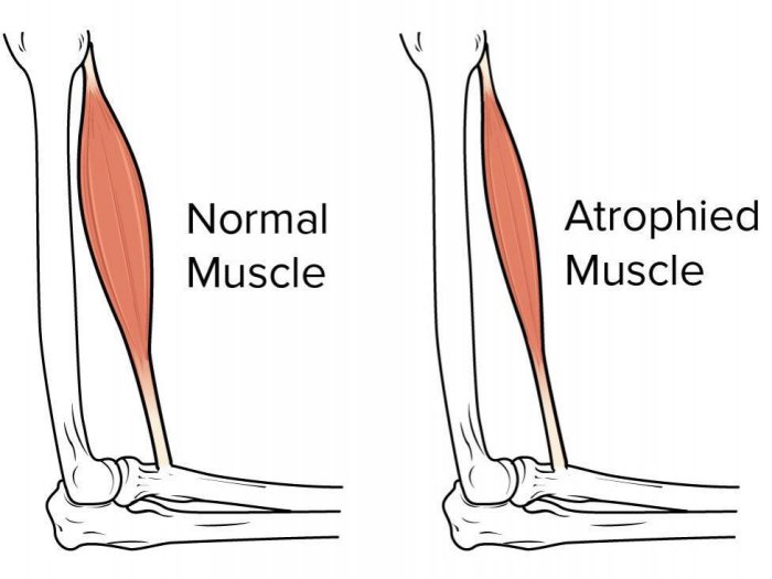 Atrophy Muscle